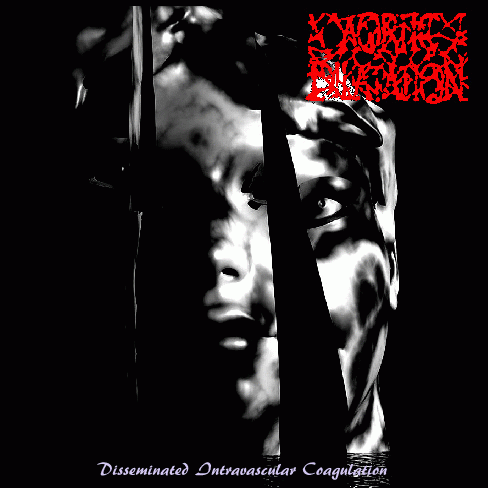 Aortic Dilatation : Disseminated Intravascular Coagulation Aortic Dilatation : Disseminated Intravascular Coagulation